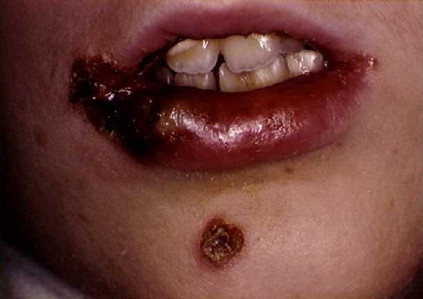 Příklady infekcí způsobených zlatým stafylokokem: Postižení kůže