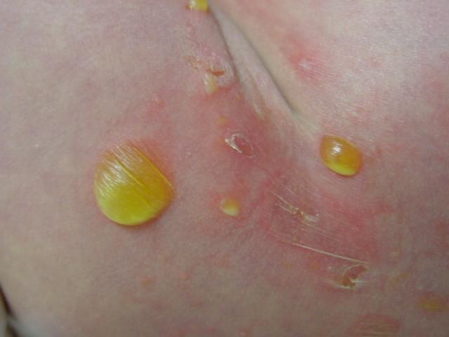 bulózní (puchýřnaté) impetigo http://www.adhb.govt.