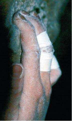 Otevřený úchop (slope grip, open hand grip) Tento druh úchopu je pro tkáně ruky ze zdravotního hlediska mnohem příznivější.