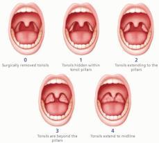 nevystupují z fossa tonsilaris neobsahují lymfocyty, nemají vazivové pouzdro 3.-4. měsíc capsula tonsillaris již vytvořena 1.
