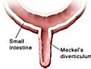 váčku s primitivní střevní kličkou) asi 2-4% populace lokalizace mezi pupkem a aborální částí tenkého