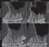 Sinus maxillaris vztah k dentici Novorozenec zubní váčky mléčných zubů odděleny Postnatálně vztah
