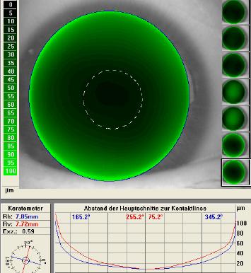 rkl > rhh KL = HH or KL > HH Flat Pseudo-flat rkl = rhh KL > HH +0,1 Butterfly rkl > rhh KL < HH Images: Gustav Pöltner After we check the fit on the slit lamp, we take the lens out and check the