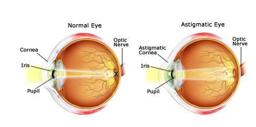 distorts the light that is projected onto the retina, the light-sensitive tissue at the back of the eye, and the patient sees a blurred or distorted image.