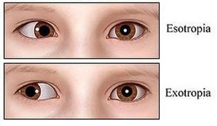 The misaligned eye can either turn inwards (esotropia) or outwards (exotropia).