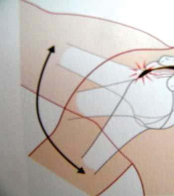 vazem b hem 70 až 120 abdukce. K impingementu dochází b hem strukturálních nebo funk ních zm n.