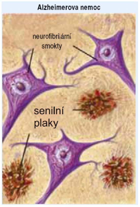 Histopatologické znaky Alzheimerovy nemoci a jejich klinické koreláty a) senilní