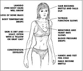 Mentálna anorexia anorexia = nechutenstvo anorexia nervosa -