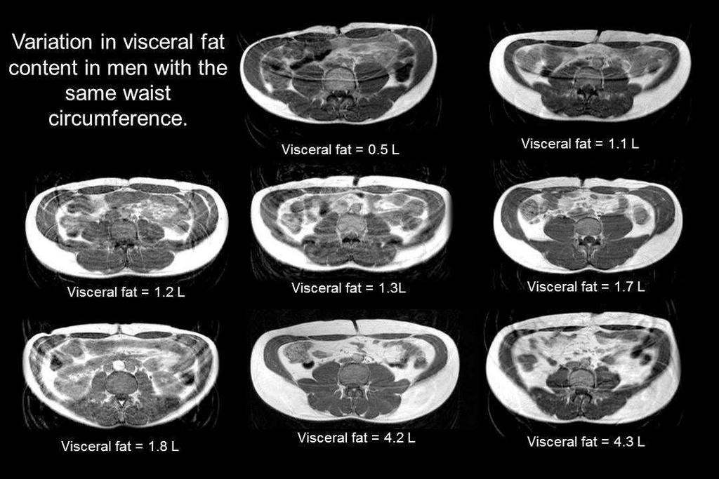 Viscerálny tuk Intraabdominálne tukové tkanivo Množstvo viscerálneho tuku a pomer subkutánneho a viscerálneho tuku závisí najmä od: Genetickej