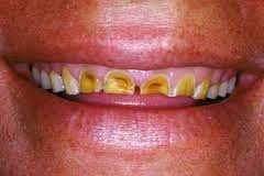 spôsobená zvracaním, hladovaním, podvýživou Zubný kaz najmä zuby s