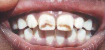 Kalcium Funkcia: Štruktúra kostí, zubov Bunková signalizácia Koenzým zrážacích faktorov Svalová kontrakcia Nedostatok: Osteoporóza, osteomalácia, rachitída Príznaky v ústnej dutine Nedostatočná