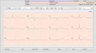 Software pro sledování, záznam a vyhodnocení zátěžového EKG splňuje nejnáročnější požadavky jak pro ambulantní provoz, tak pro