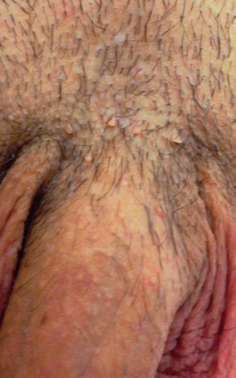 Diferenciální diagnóza Akuminátní kondylomata je nutno odlišit od sebaceózních genitálních žlázek, perlových penilních papulí, vestibulárních papulí, maligního melanomu v genitoanální lokalizaci,