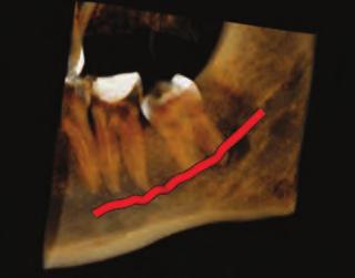 0 nabízí dvojrozměrné náhledy před samotným použitím CBCT, což umožní ověřit přesnou polohu pole vidění s možností upravit jeho umístění a velikost.
