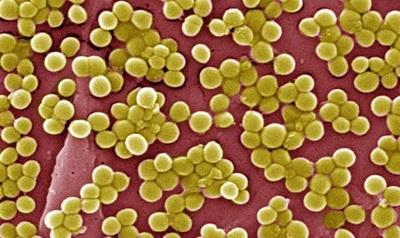 SSS syndrom - charakteristika Staphylococcus aureus SSSS - Staphylococcal Scalded Skin Syndrome Původce nákazy: Staphylococcus aureus s hyperprodukcí exfoliativního toxinu (ET) Klinické kmeny v ČR