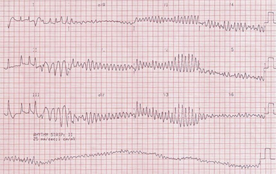 smrt -EKG