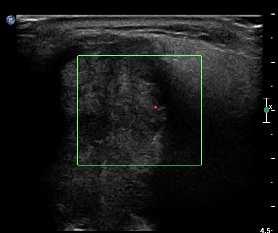 Pleomorfní fibrosní histiocytom Heterogenní, prokrvácená, hluboko