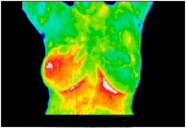 php/pro-a-proti Obrázek 4: Termografický snímek prsu s