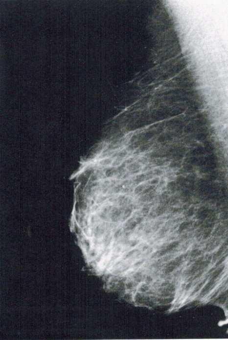Obrázek 8: Snímek prsu v mediolaterální projekci Zdroj: Eugene D. Frank, Bruce W. Long, Barbara J. Smith.