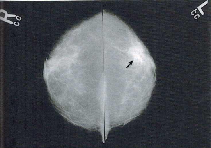 425 Obrázek 9: Snímek prsu v kraniokaudální projekci Šipka zobrazuje zachycenou patologii prsu. Zdroj: Eugene D.