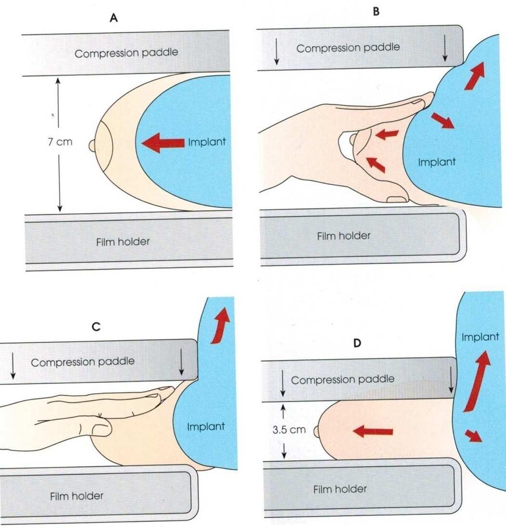Obrázek 17: Schéma zobrazující postup odtlačení implantátu při projekci na implantovaný prs Obrázky A a B ukazují klasickou zobrazovací pozici.