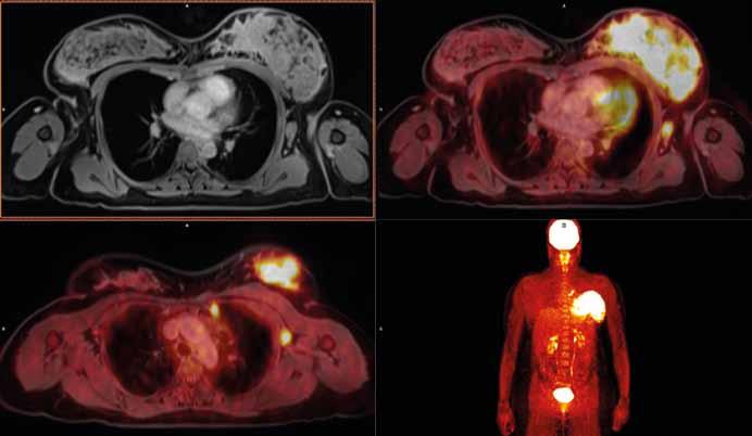 Triple negative inflammatory gestational ductal invasive carcinoma in 36 years old woman, T4dN2cM0, clinical stage IIIC.