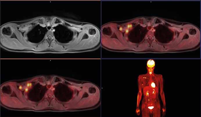 Triple negative ductal invasive carcinoma in 30 years old woman bearing the gene BRCA1, T1cN3aM0, clinical stage IIIC.