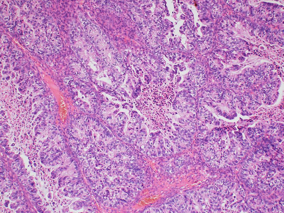 Imunohistochemická exprese proteinu p53. Normální typ exprese (tzv. wild-type ) je charakterizován jadernou pozitivitou různé intenzity obvykle v < 50 % nádorových buněk (A).