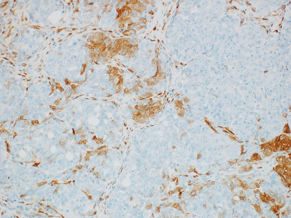 Tabulka 2. Exprese vybraných imunohistochemických markerů v karcinomech ovaria.