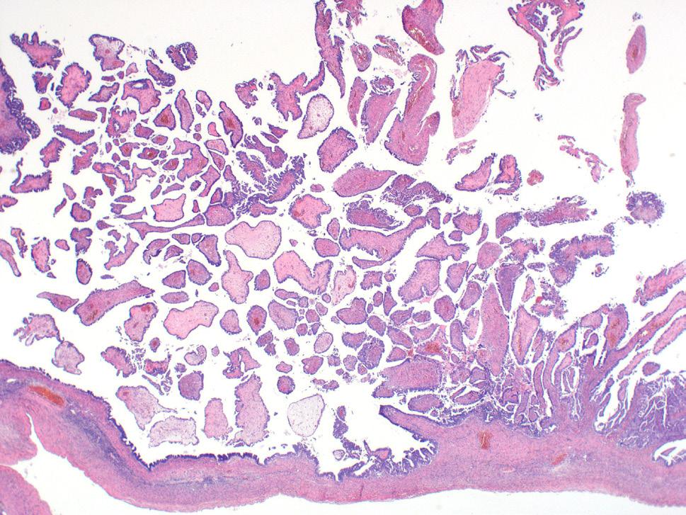 Tabulka 4. Histologická klasifikace epitelových a smíšených epitelových a mezenchymálních nádorů ovaria (WHO 2014).