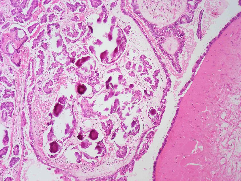 Pomoci může i imunohistochemické vyšetření - ve většině případů HGSC je aberantní typ exprese p53 a častá je difúzní tzv. bloková pozitivita p16.