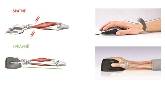 UTB ve Zlíně, Fakulta technologická 13 1.2 Ergonomie počítačových myší Syndrom karpálního tunelu tzv. počítačová nemoc je jedním z hlavních důvodů, proč ergonomické počítačové myši vznikly.