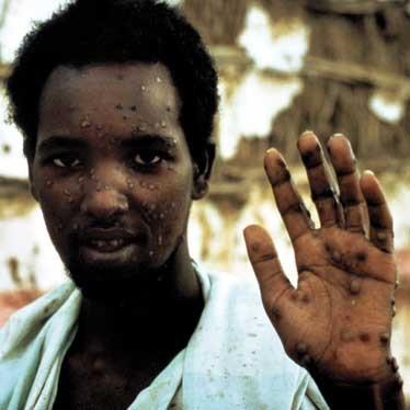 26. října 1977 byl posledním případem přirozeně se vyskytující varioly (variola minor) Ali Malow Maalin, kuchař pracující v nemocniční kuchyni v Somálsku 17.