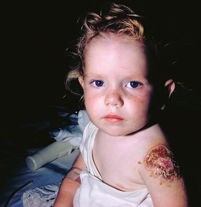 Nežádoucí účinky vakcíny 1 z 1000 utrpěl váţnou reakci po první vakcinaci: toxické a alergické projevy v místě vpichu (erythema multiforme) 14-500 z 1 milionu