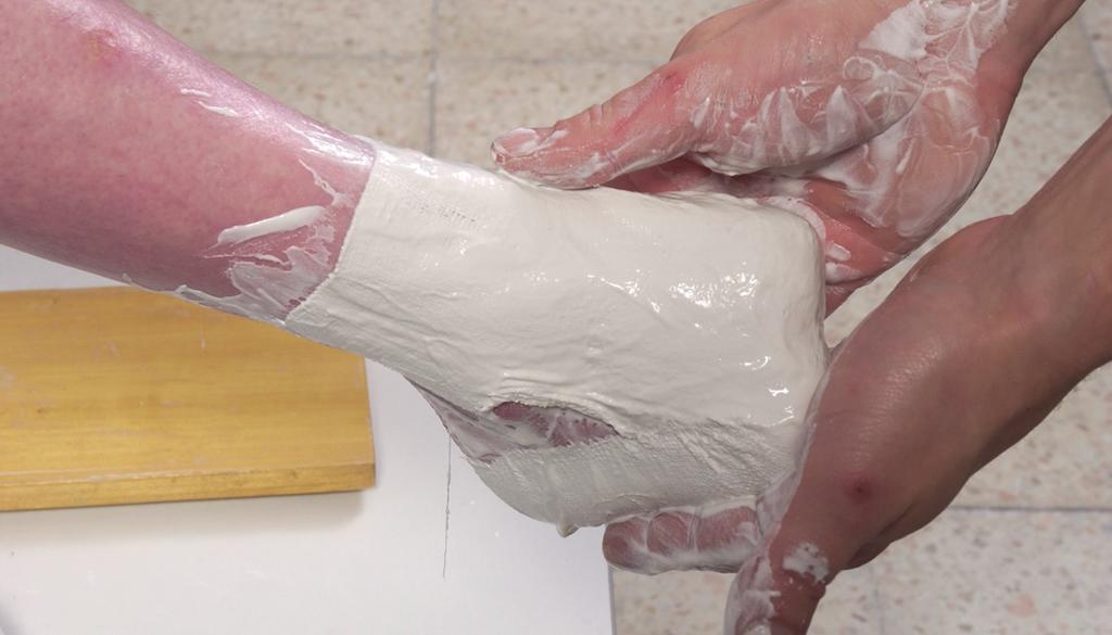 3 Druhá fáze sádrového otisku Ve druhé fázi zhotovení sádrového otisku se