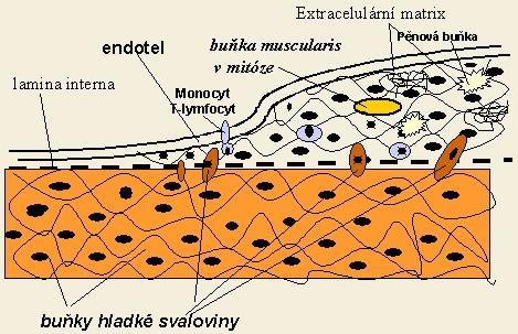 Obrázek 4.: Schéma ztlušťování stěny artérie v průběhu aterogeneze (14). 2.3.2.1 Faktory patogeneze aterosklerózy (aterogeneze) LDL-částice.