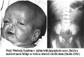 Fetální warfarinový syndrom Poruchy kalcifikace Dysmorfie obličeje plochý obličej,