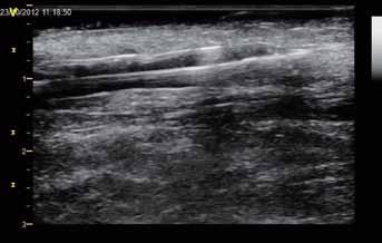 8. B-mode ultrasonography image of the vein after PTA nabízí možnost užití ultrazvuku k navigaci PTA.