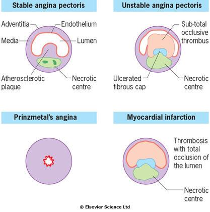 Angina Srdeční syndrom X je u pacientů s pozitivní anamnézou anginózních bolestí, pozitivním zátěžovým testem a normálním koronarografickým nálezem. Heterogenní skupina, častější výskyt u žen.
