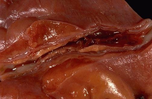 Ateroskleróza komplikace trombóza