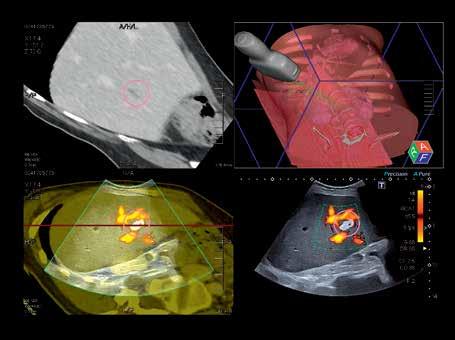12 Funkce Smart Fusion kombinuje ultrazvuk v reálném čase s dříve získanými daty z CT, MR nebo UZ, a umožňuje tak snadnou identifikaci a porovnání lézí a bezpečnou navigaci u