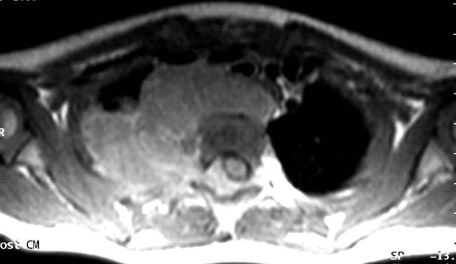 Syndrom míšního útlaku (spinal cord compression, SCC) odklad léčby zpravidla působí trvalou invaliditu neuroblastom, sarkomy, lymfomy, nádory CNS mechanismus: přímá invaze cestou foramina