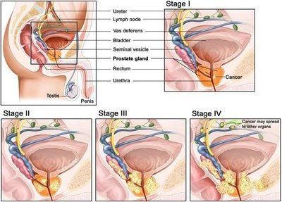 V klinické praxi se často používá i následující dělení: LOKALIZOVANÝ KARCINOM (bez šíření mimo hranici pouzdra prostaty), tj.