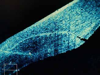Fototermální lasery Absorbce energie laserového záření v tkáni vede ke zvýšení teploty.