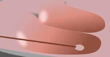 Použití laseru v otolaryngologii Lasery v otologii Oblast ucha nenabízí velkou realizaci pro laserové přístroje.