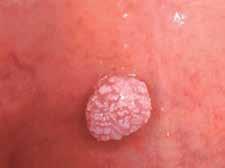 měly být všechny tumorózní útvary histologicky vyšetřeny, je třeba do terapeutické rozvahy integrovat i požadavky na následné bioptické vyšetření.