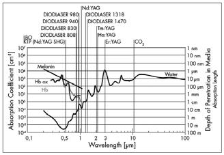 V léčbě urolitiázy se datuje první využití laseru do roku 1987, kdy Dretler a kol. použili barvivový laser ke fragmentaci litiázy.