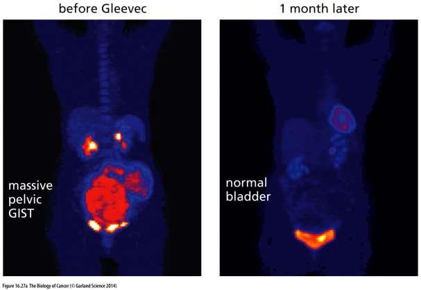 Off-target aktivita imatinibu Gleevec (imatinib mesylate) Jen 4 z 90 TK jsou inaktivovány (BCR-ABL, v-abl, PDGFR, Kit)