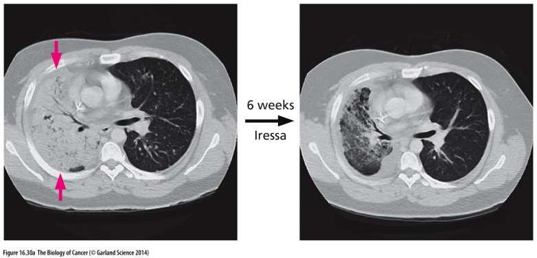 Tarceva (erlotinib) a Iressa (gefitinb) 2004-2005 Schváleny pro terapii nemalobuněčného