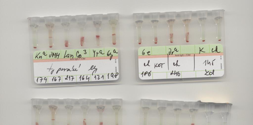Obrázek 23: Reakce protilátky o známé specifitě s erytrocyty vyšetřovaného vzorku Na erytrocytech pacienta jsme prokázali